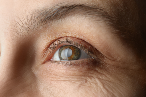 Comprendre la cataracte : causes, symptômes et solutions - Optical ...